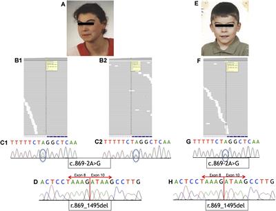 Mosaic Intronic NIPBL Variant in a Family With Cornelia de Lange Syndrome